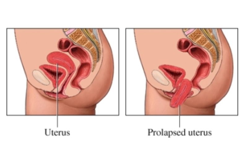 https://www.shadygrovegyncare.com/wp-content/uploads/2018/06/Global-Women-Connected-Prolapse-uterus.png