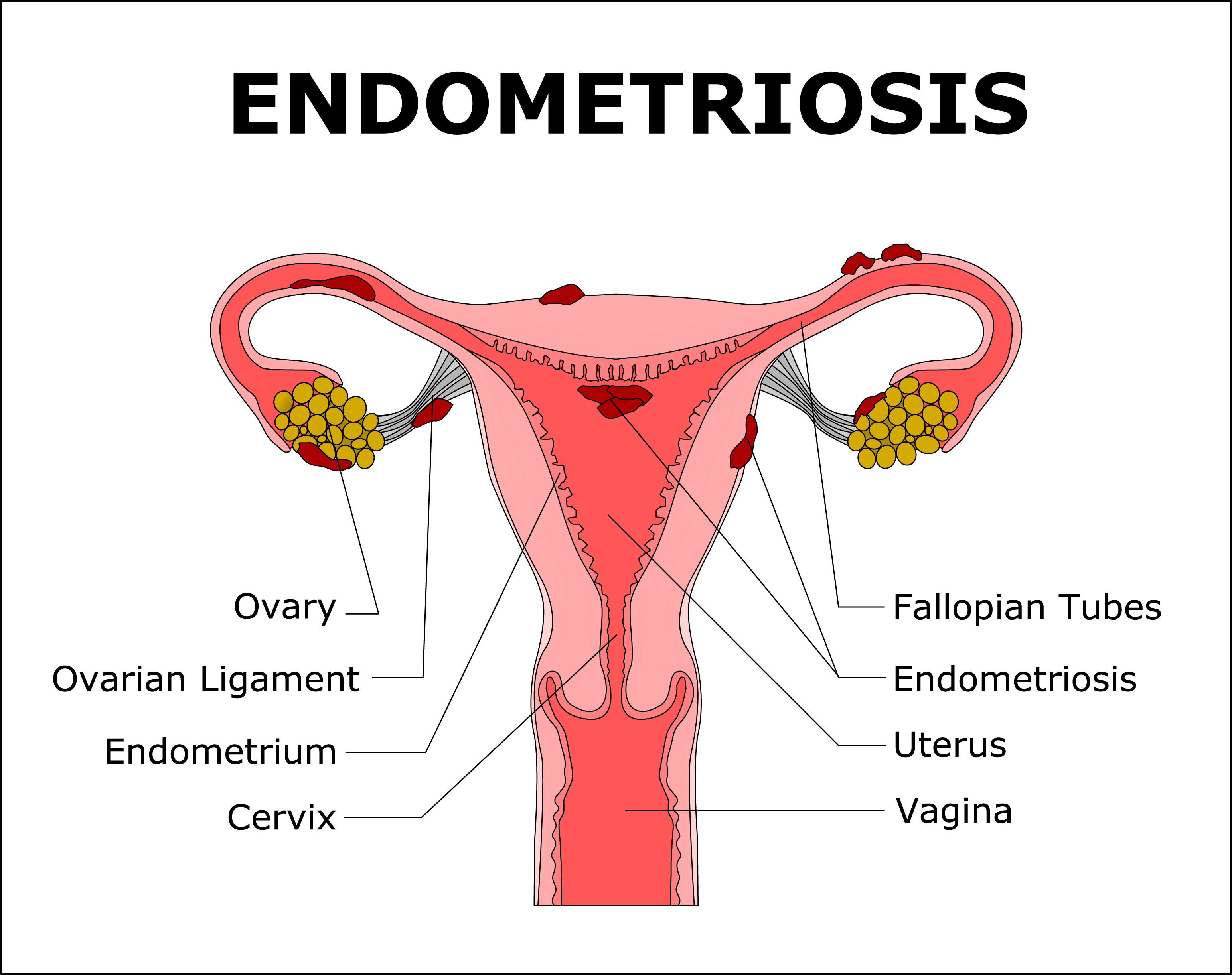 Endometriosis Treatments Rockville